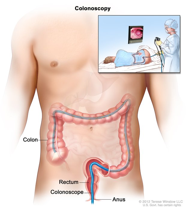 A colonoscopy can be useful in visualizing masses in the GI tract, act well as collecting tissue from it as well (source) 