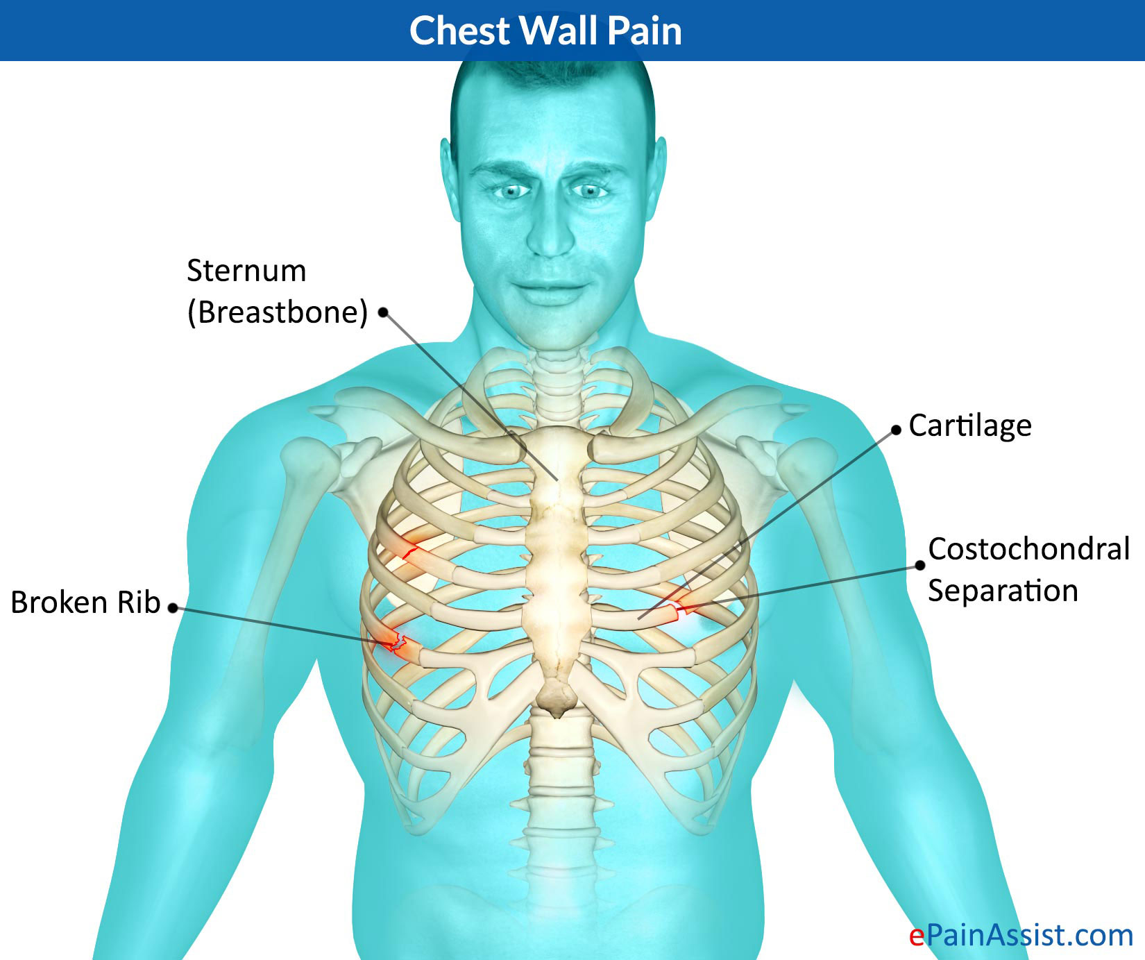 Chest wall pain can be a fairly generic term. In the case of this patient it refers to musculoskeletal causes of chest pain (although serious issues such as rib fractures have been ruled out with the chest X-ray, source)