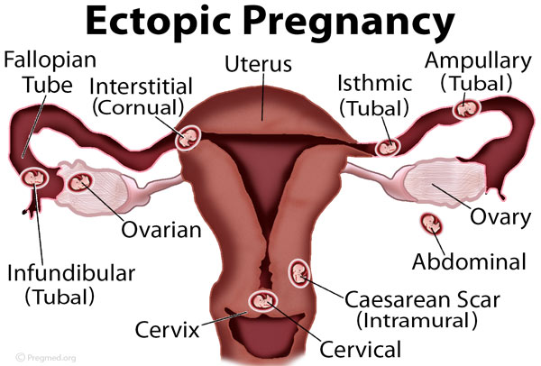 An ectopic pregnancy can occur throughout the different structures that constitute the female anatomy (source)