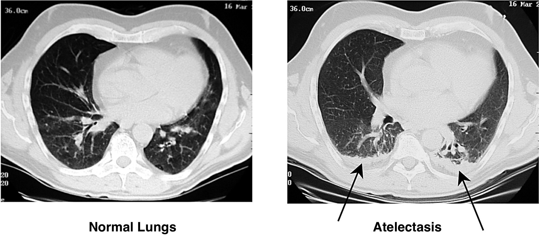 Visual appearance of atelectasis on a CT scan (right pane). Normal lungs provides as reference (left pane, source)