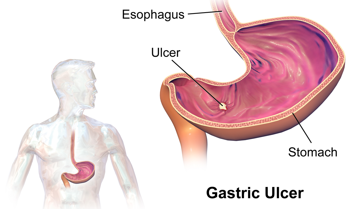 Gastic ulcers can cause serious GI bleeds. In the case of this patient, the bleeding was so severe he needed to be managed in the ICU (source)