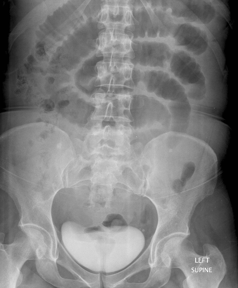 Due to gravity, the supine view of a KUB for a SBO patient often will not demonstrate the present of air/fluid levels. With this in mind (and as is the case in the image above) dilated bowel loops can be observed in this view (source)