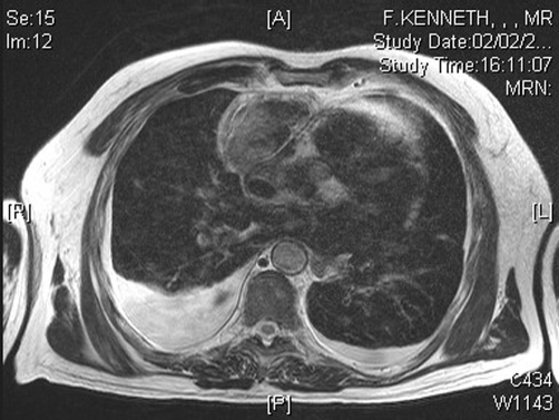 MRI showing bilateral pleural effusion (source). 