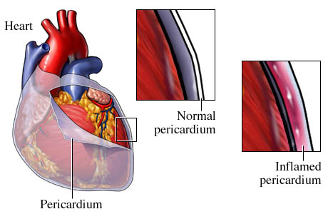 Pericarditis/pericardial effusions are serious causes of chest pain that need to be ruled out. That being said, these conditions will often present much differently then the patient discussed on this page (source).
