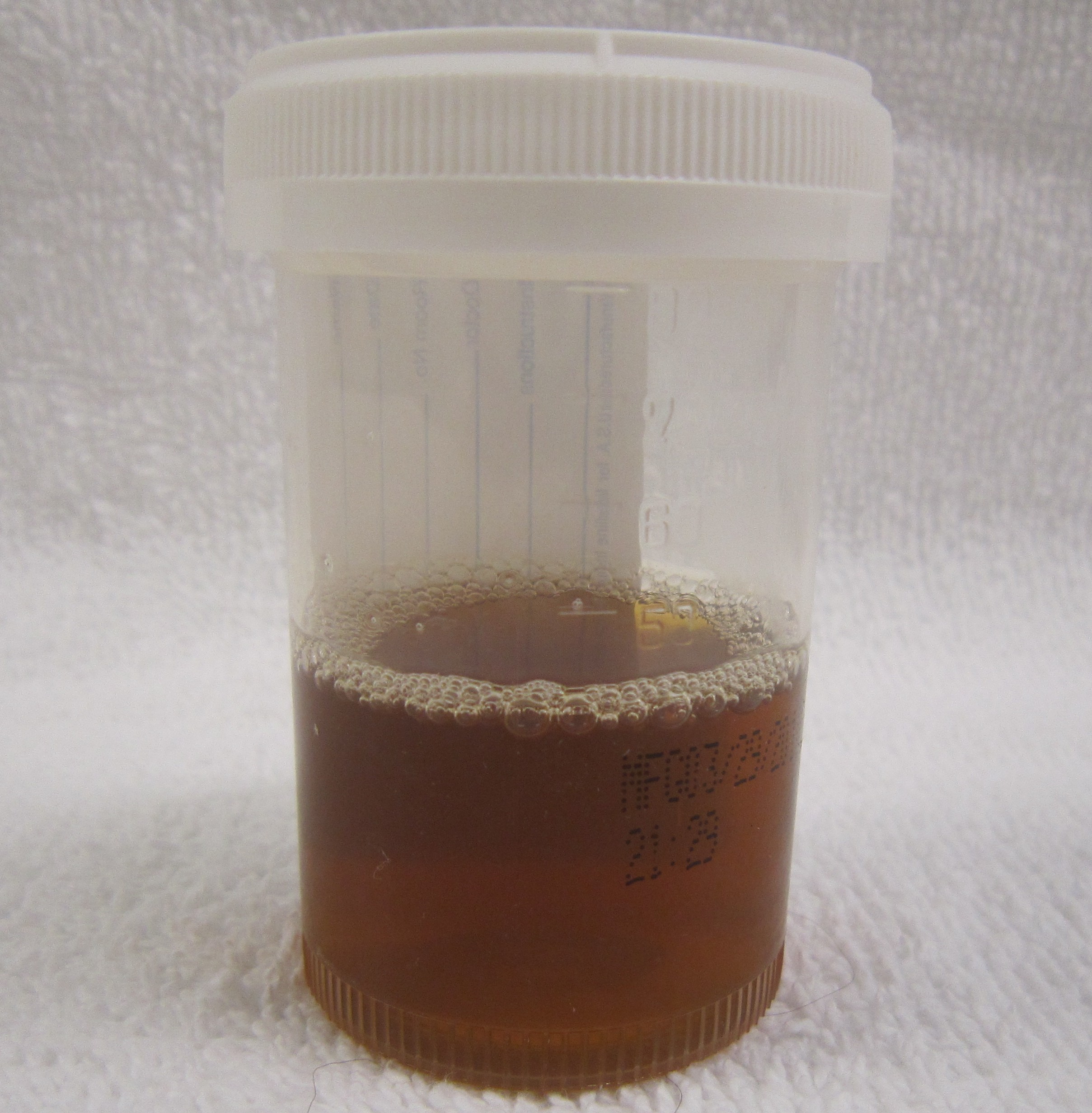 The patient's red urine concerns her and is the tipping factor in her deciding to seek medical care (source) 