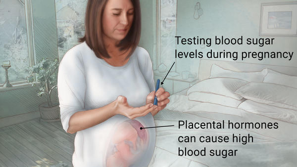 Gestational diabetes can be an important complication during pregnancy to evaluate for (source) 