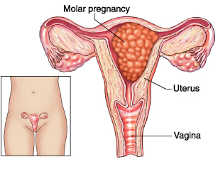 One example of a molar pregnancy (source)