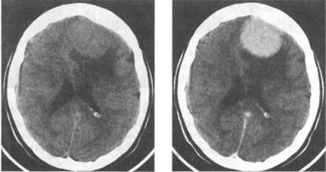 CT scan of a cranial meningioma before (left pane) and after (right pane) the administration of IV contrast (source)