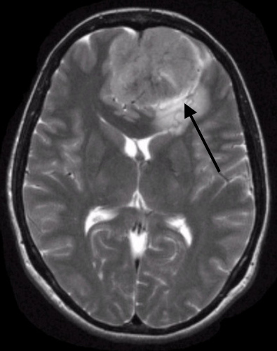 T2 axial image of a cranial meningioma. The arrow points to the presence of CSF in the "cleft" between the tumor and brain parenchyma. This is a feature that is characteristic of a meningioma (source) 