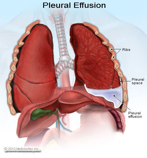 This schematic shows the anatomical location of where fluid collects in a pleural effusion. It is in the pleural space between the parietal and visceral pleura (source).