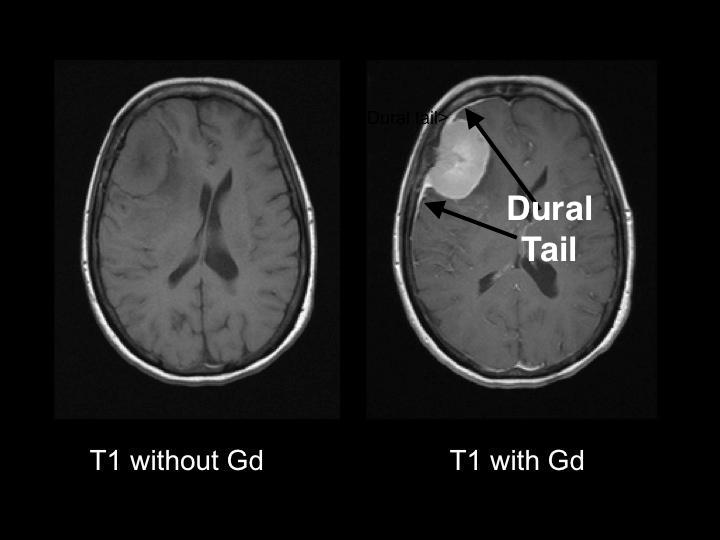 Appearance of meningioma on a T1 weighted MRI image before and after contrast enhancement. The characteristic "dural tail" can be seen on the right pane with enhancement (source). 