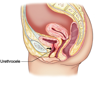 Visual representation of a urethrocele (source).