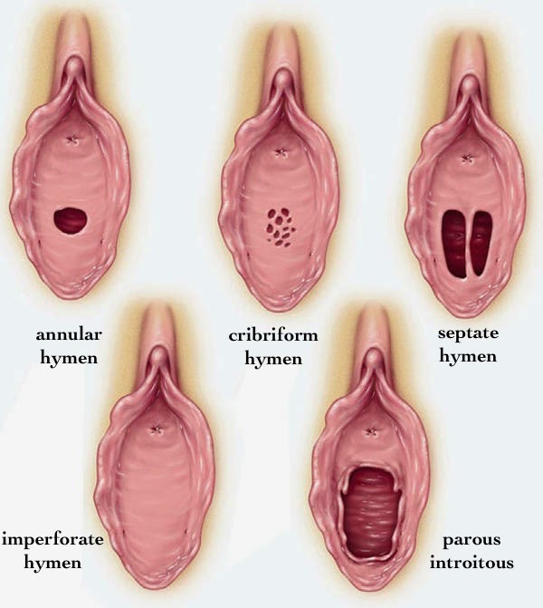 The various types of hymens (source)
