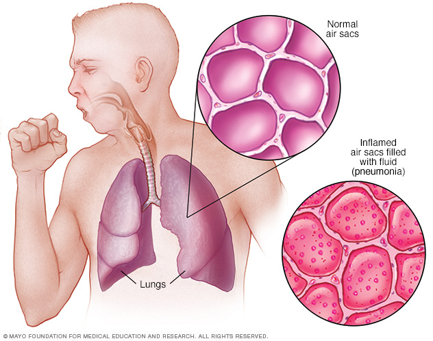Figure depicting pneumonia (source). 