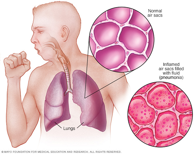 Figure depicting pneumonia (source).