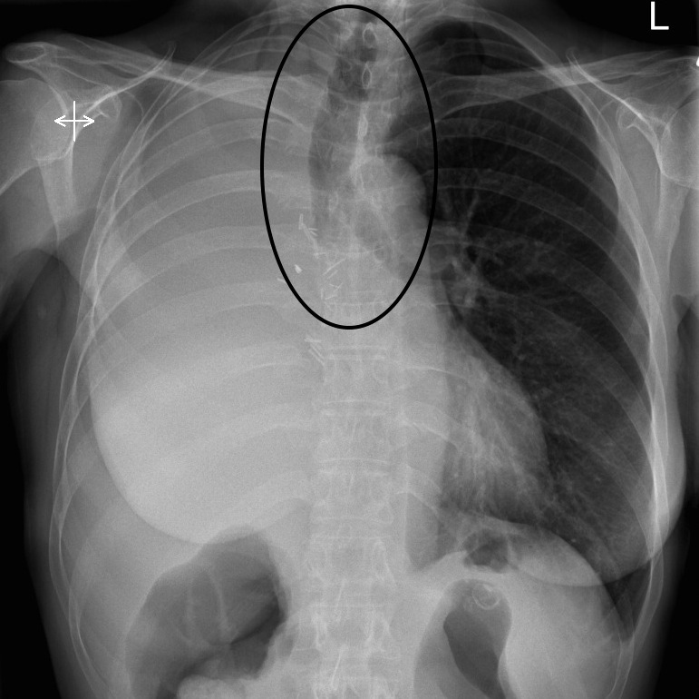 In this example of hemithorax opacification, the cause of the finding is a pneumonectomy. The airway is shifted toward the side of the opacification (source). 