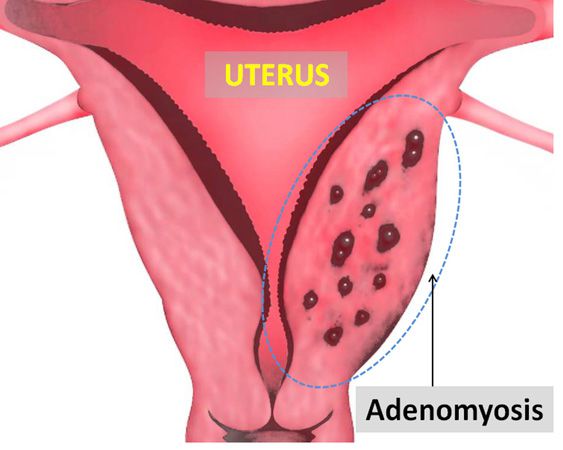 Adenomyosis is a condition characterized by the presence of endometrial tissues within the myometrium of the uterus (source)