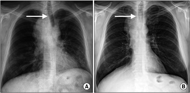 In pane A a large mass around the trachea has caused significant deviation. In page B this issue has been resolved and the trachea is midline (source)