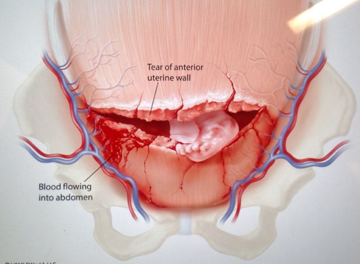A uterine rupture is a self descriptive condition. It is a very serious complication given its nature (source)