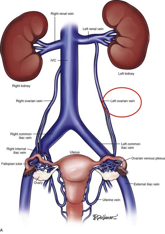 Left Ovarian Vein - Stepwards