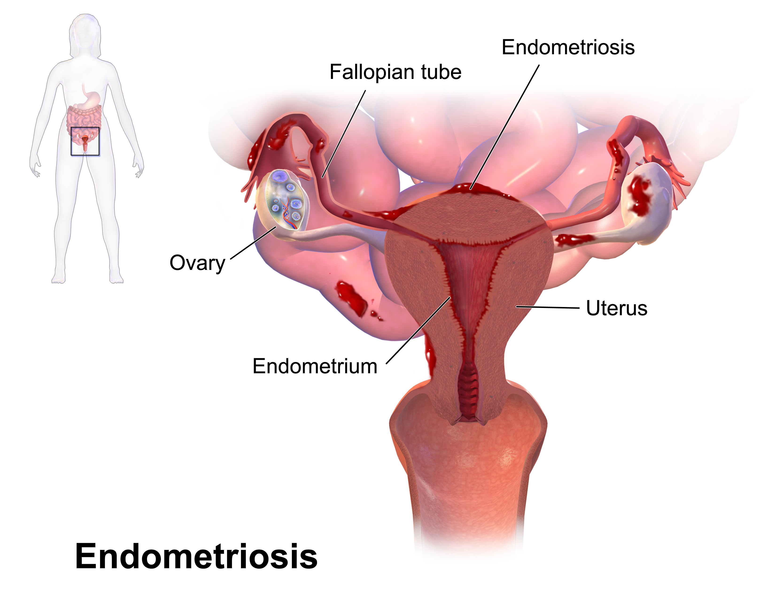 Endometriosis is characterized by the presence of ectopic endometrial tissue (source)