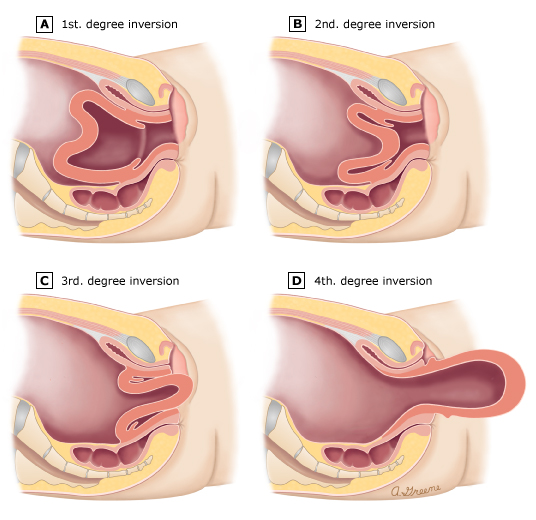 Uterine inversion is a serious complication, and it can also be classified in the manner explained above (source)
