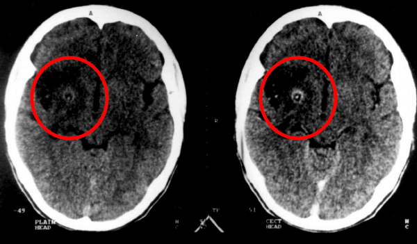 This is an axial CT scan of the brain. The pane on the left is without contrast, and the pane on the right is after IV contrast administration. The ring enhancing lesion can be clearly seen (source). 