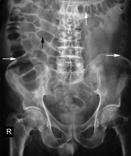 Appearance of large bowel on a KUB. Note the haustra (folds of the bowel) that do NOT span the entire lumen (source)