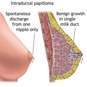 Intraductal papilloma male breast