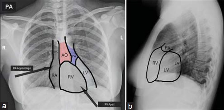 The general locations of the heart chambers can be estimated on a chest X-ray (source). 