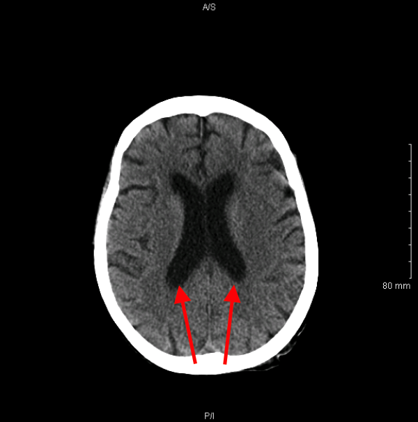 Visualization of the left/right lateral ventricles on an axial, non-contrast head CT scan (source) 