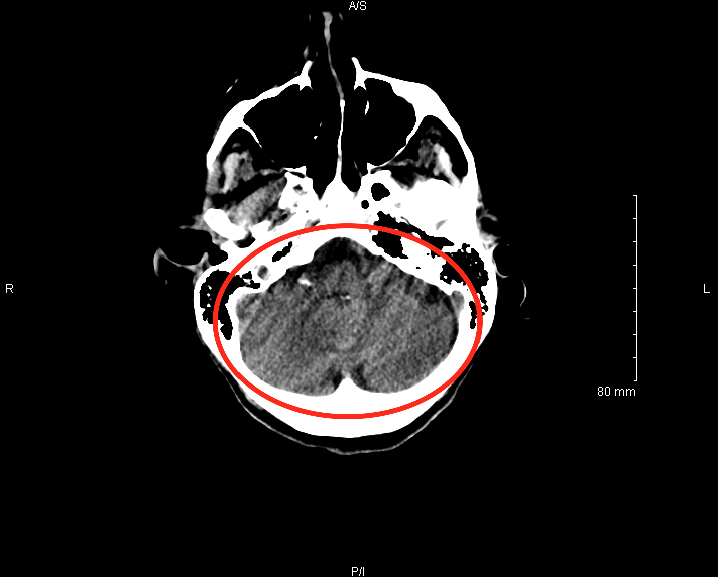 Visualization of the cerebellum on an axial, non-contrast head CT scan (source) 