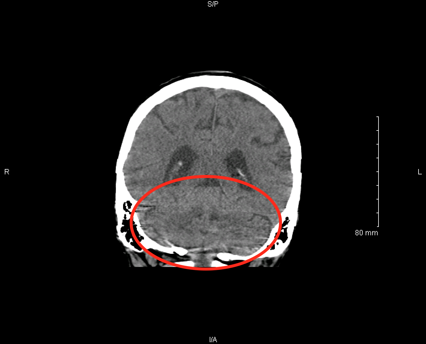 Visualization of the cerebellum on an coronal, non-contrast head CT scan (source) 