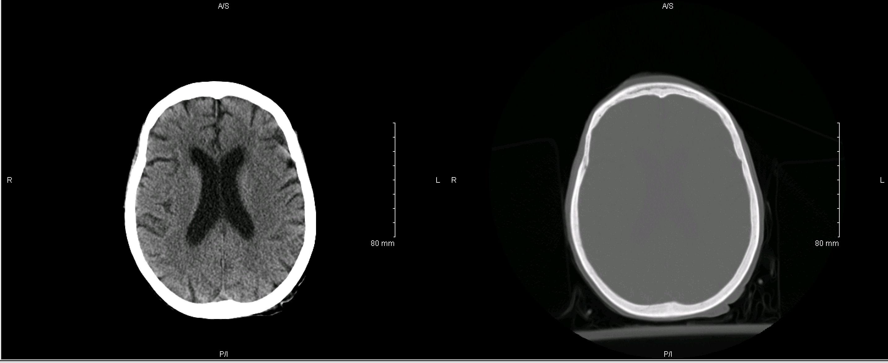 These are axial sections of a non-contrast head CT scan. The pane on the left is the BRAIN WINDOW and the pane on the right is the BONE WINDOW. One can appreciate how these different windows help with analyzing the brain and bone respectively (source)