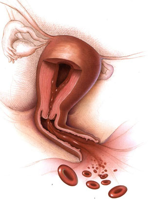 Abnormal uterine bleeding is a self descriptive condition that can have many different etiologies (source)