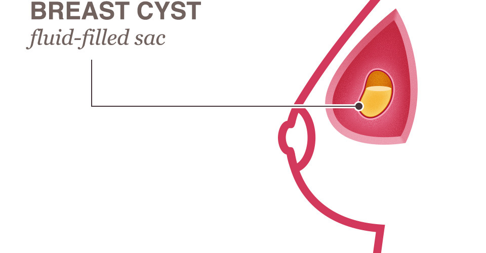 A simple breast cyst is a benign condition, but can concern patients who can find it as a "lump" on self examination (source)