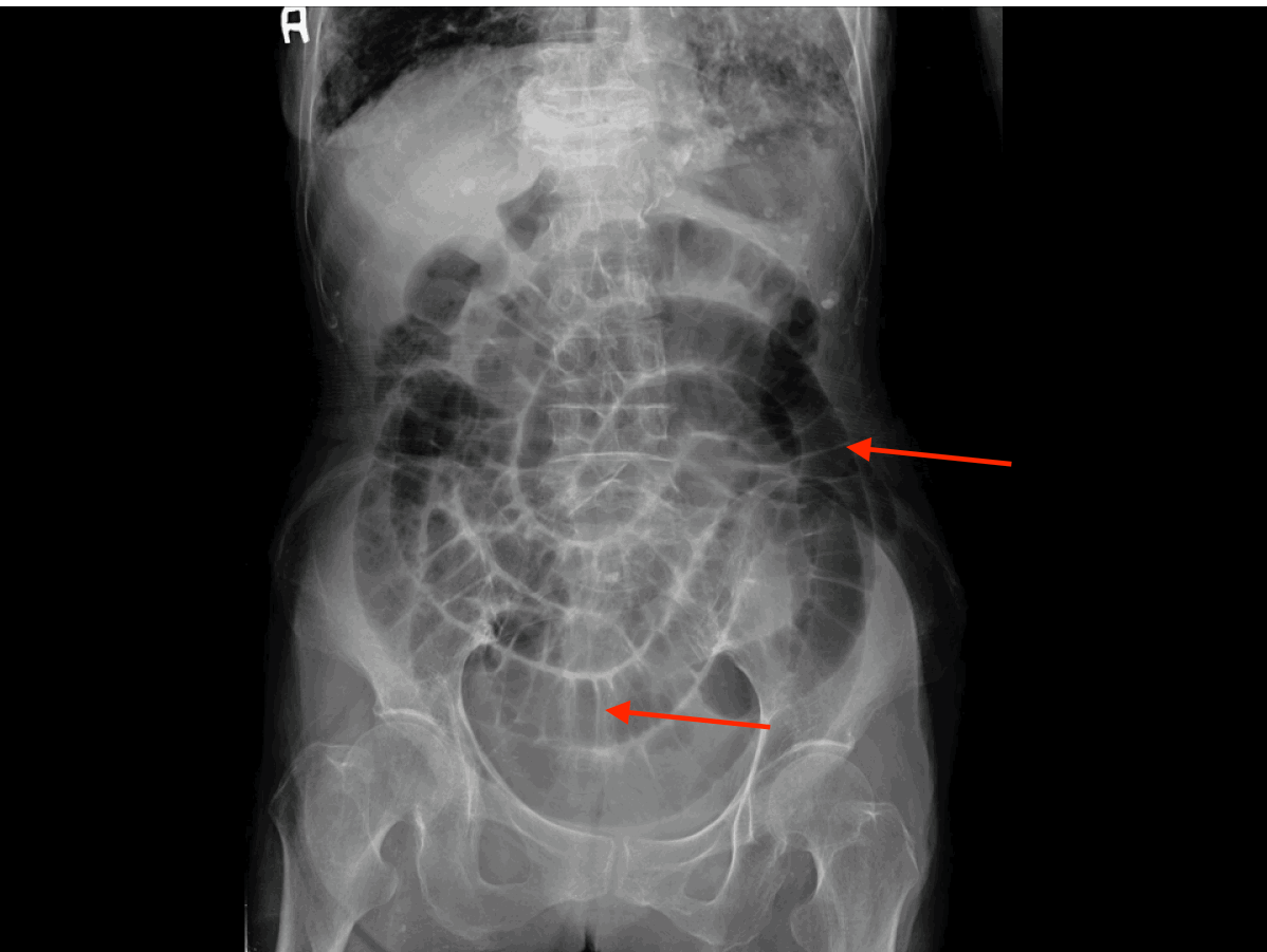 Appearance of small bowel on an abdominal X-ray. Notice that valvulae (folds of the small intestine marked by red arrows) should extend across the whole length of the lumen of the small bowel. This is NOT a unremarkable study, the small bowel is diffusely dilated, which makes it easier to see (source)