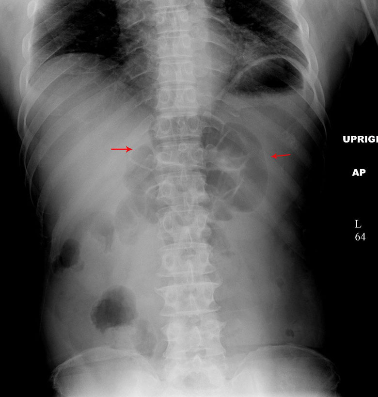 This upright KUB shows a focal ileus (red arrows) in a patient with pancreatitis (source)