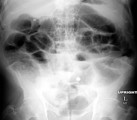 This X-ray shows a generalized ileus where all the bowel loops (both large and small) are involved (source)