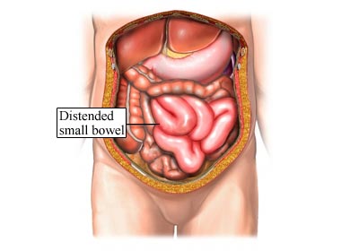 The loss of contractions/muscular tone throughout the intestines will lead to bowel dilation. Whats more, waste will be unable to move effectively thought the GI tract (source)