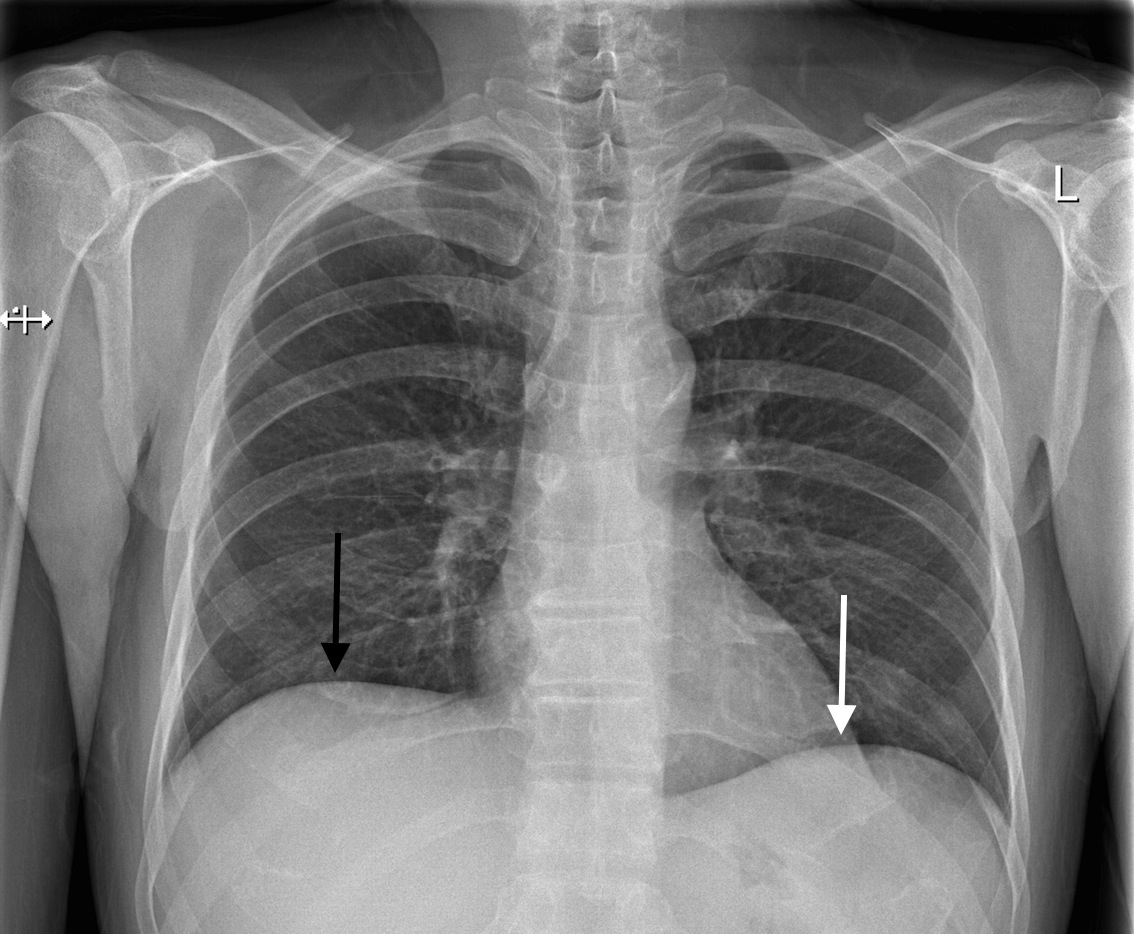 The right diaphragm (black arrow) is generally at a higher level then the left diaphragm (white arrow). This is because the liver rests under the right diaphragm and pushes it superiorly (source). 