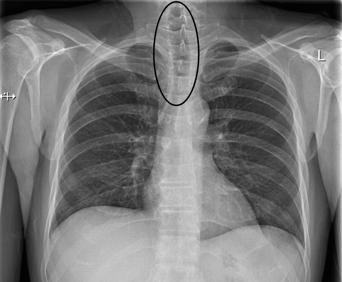 The trachea (circled) appears slightly darker then surrounding structures because it is air filled. X-rays will have an easier time penetrating this structure to develop the film behind the patient (source)