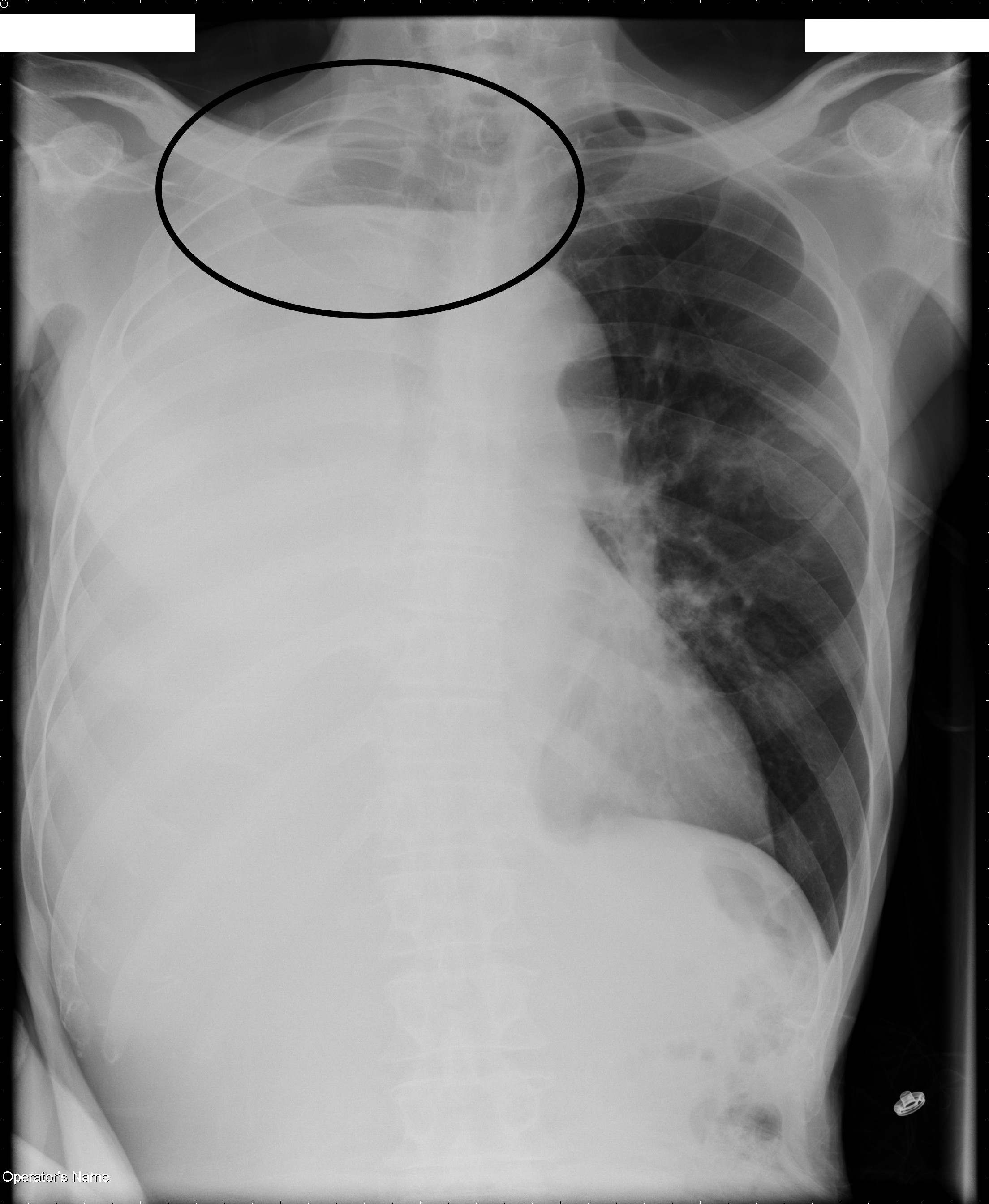 At the right apex of the lung we can clearly see an air fluid level that strongly suggests that this hemithorax opacification is caused by a large pleural effusion (source). 