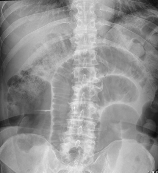 The above film is a supine abdominal X-ray. It shows dilated bowel loops quite clearly. In this case these dilated bowel loops are caused by a small bowel obstruction, however this may not always be clear (source). 