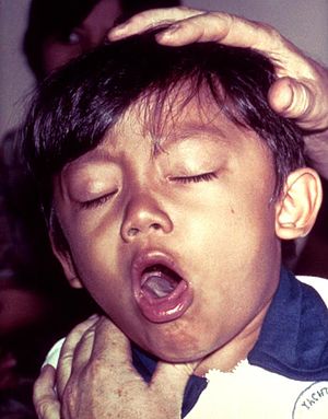 Pertussis is characterized by its distinctive "whooping cough" (source)