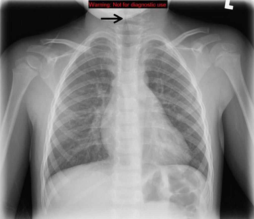 Chest X-ray in a child with croup that shows the charactersitic "steeple sign" marked by the arrow (source)