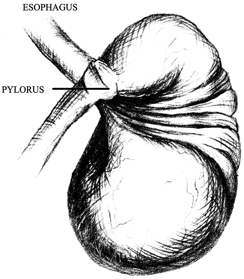 Artistic rendering of gastric volvulus (source) 