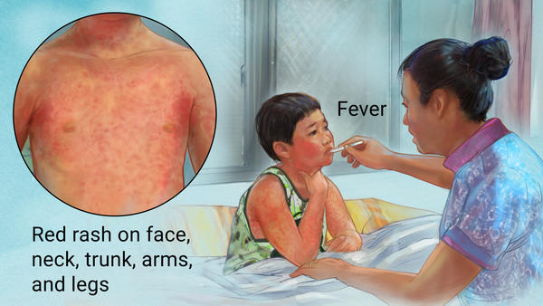 Scarlet Fever Rash  YourCareEverywhere