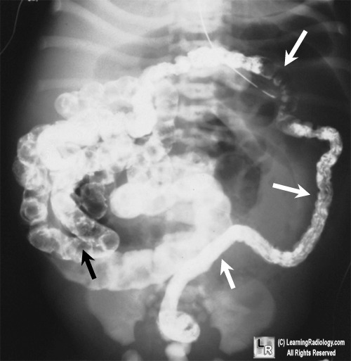 At top, a conventional radiograph of a newborn abdomen shows a "mass" in the right lower quadrant (white arrow) made up of loops of ileum with inspissated meconium, markedly dilated loops of bowel (black arrow) and a "soap-bubbly appearance to the meconium (white oval). In the contrast enema on the bottom, a small, unused microcolon (white arrows) is seen and there are filling defects representing meconium pellets in the terminal ileum and colon (black arrow). Case from learning radiology.com (source)