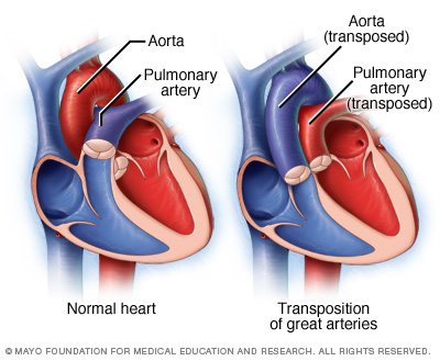 Comparison of a normal heart with one that has the great vessels transposed (source)